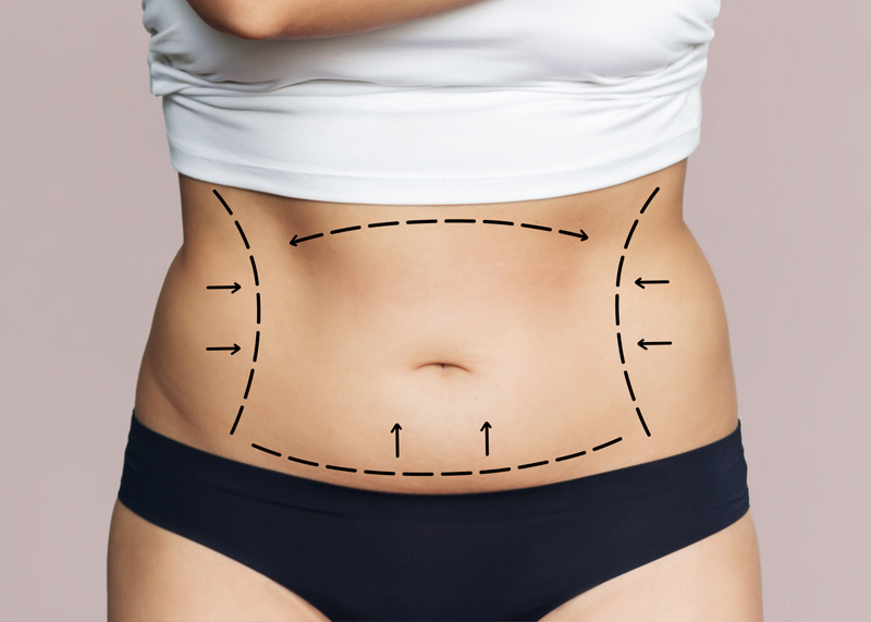 Abdominoplastia